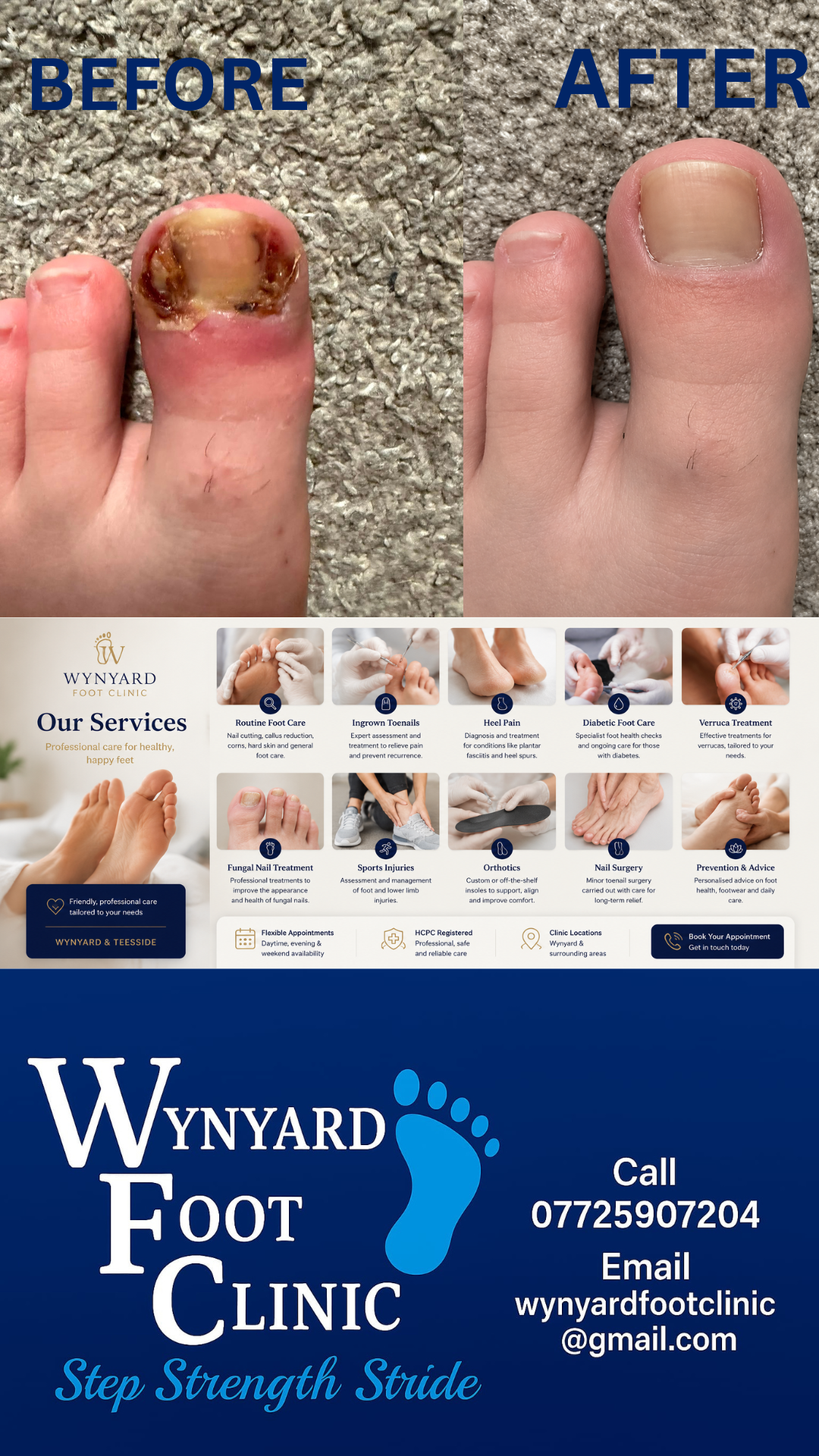 Ingrown Toenails – Causes, Symptoms, Treatment & When Surgery Is Needed
